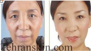 رادیوفرکونسی و جوانسازی پوست