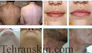 لیزر موهای زائد در کلینیک زیبایی آلومینا