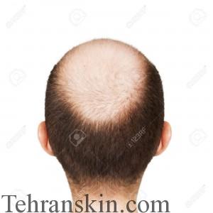 9944683-Human-alopecia-or-hair-loss-adult-men-bald-head-Stock-Photo