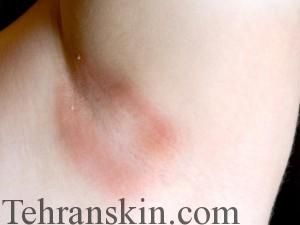 BGHT_017_LaserHairRemovalSideEffects_THUMB_640x480_KL