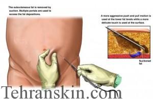 رایج ترین روش جراحی زیبایی که بسیاری از بیماران بدلیل خطرات احتمالی که بهمراه دارد از انجام آن خودداری می کنند، لیپوساکشن است. 