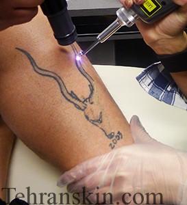 Revolution-Tattoo-Treatment-web