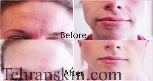 forehead-mouth_before-after