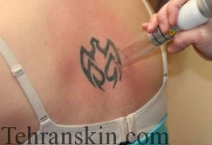 laser-tattoo-removal