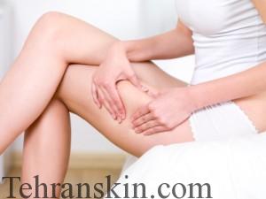 Woman folding skin on her hips