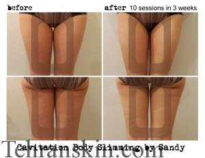 از بین بردن سلولیت به کمک فراوادرمانی