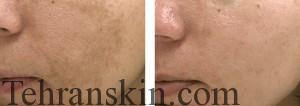 تصاویر قبل و بعد از لیزر لک های پوستی
