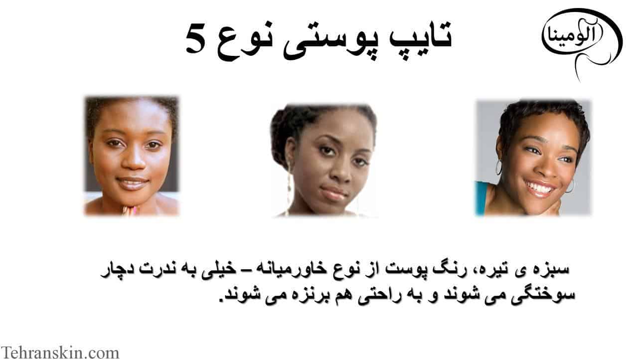 تایپ پوستی نوع 5