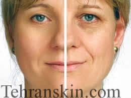 جوانسازی صورت 2