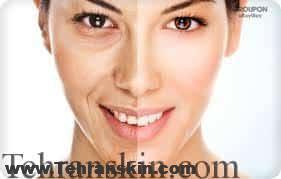 جوانسازی صورت 3