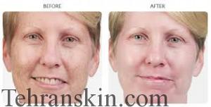 جوانسازی پوست