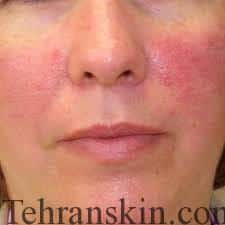 جوش و روزاسه1