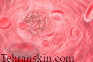 جوش وروزاسه