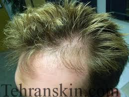 ریزش مو اقایان 2