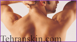 نتیجه تصویری برای لیزر درمانی برای حذف مو های کمر و پشت مردان