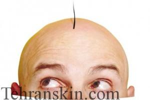 نقش ژن در ریزش مو