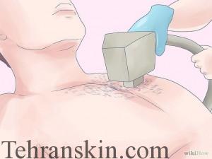 لیزر موهای زائد