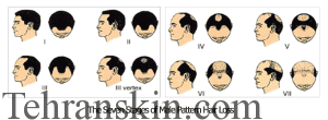 علل ریزش موی مردان