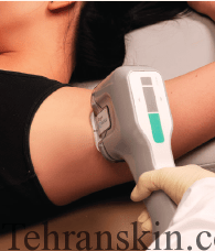 کاربرد ریزموج ها در رفع موهای زائد زیر بغل