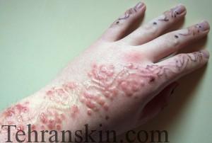 هشدار درباره استفاده از تتو موقت