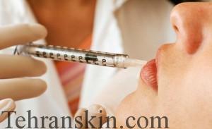  تزریق دارو به لایه های زیرین پوست