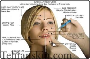 تزریق بوتاکس