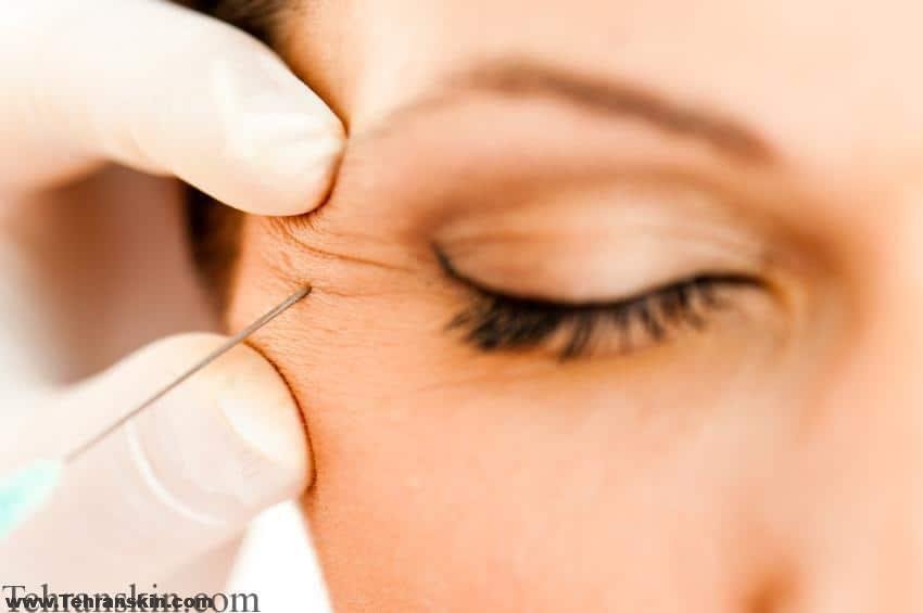 روش جایگزین بجای بوتاکس که چروکها را از بین می برد | تزریق بوتاکس، نتیجه، هزینه، عوارض