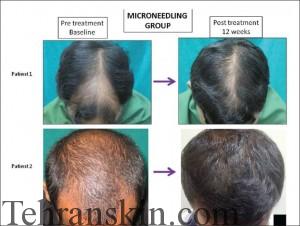 میکرونیدلینگ سر