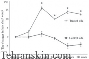 نمودار ریزش مو