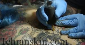 از بین بردن جای خالکوبی