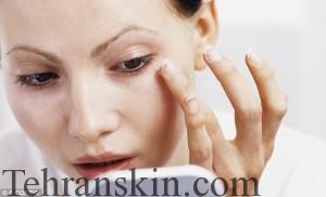 بروز لکه های سیاه بر سطح پوست صورت