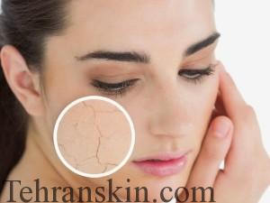 تحریک پوست4