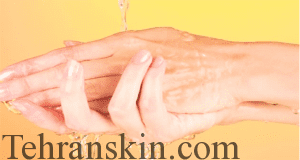 درمان سوختگی