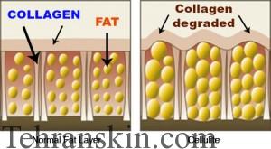 سلولیت چیست
