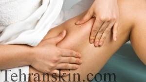 سلولیت چیست0