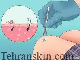 موی زیر پوستی0