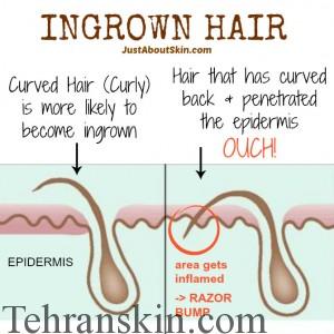 موی زیرپوستی