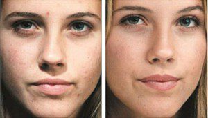 میکرودرم ابریژن