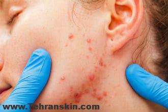 اشتباهاتی که باعث می شود جوش صورت خوب نشود