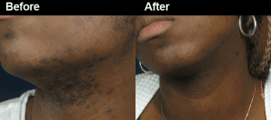 پوست تیره 23