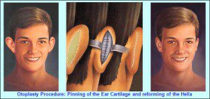 جراحی زیبایی گوش