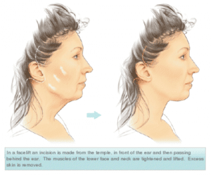 رفع چین و چروک گردن