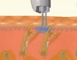 لیزر بیکینی و خطر ناباروی زنان و کاهش نعوظ و اسپرم در مردان آیا واقعیت داره؟