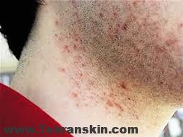 فاصله بین جلسات لیزر موهای زائد