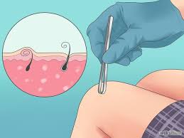 موی زیر پوستی