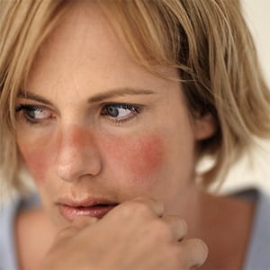 انواع لوپوس