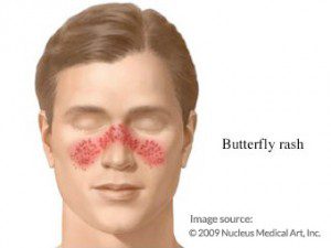 شکل زیبایی لوپوس