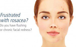 درمان روزاسه با دارو