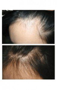 female-hair-loss-before-after-gallery