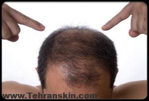 ریزش موی مردانه
